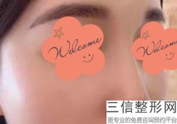 肋骨隆鼻维持多久再次弄好呢(肋骨隆鼻维持多久再次弄好呢图片)