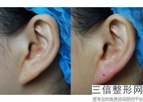 隆鼻假体加耳软骨可以一辈子吗(做假体隆鼻加耳软骨好不好)