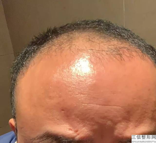 毛发移植是植发吗(毛发移植是植发吗)