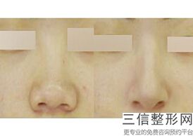 美容整形医院假体隆鼻多少钱(美容整形医院假体隆鼻多少钱一次)