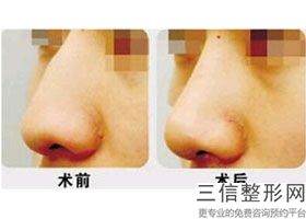 哪里做隆鼻好(整容医生免费咨询)