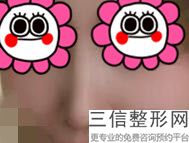 深圳鹏爱医疗美容医院肋软骨隆鼻价格(深圳鹏爱整容医院)