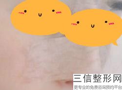 缩鼻翼手术风险大吗(缩鼻翼手术风险大吗多少钱)