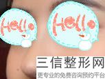 缩鼻翼要恢复多久(缩鼻翼要恢复多久才好)
