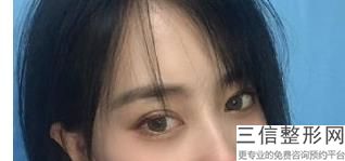 现在埋线双眼皮要多少钱一次(现在埋线双眼皮要多少钱一次呢)