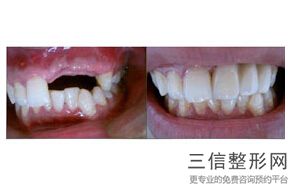 牙齿矫正手术怎么做(牙齿矫正手术怎么做的,快速的吗)