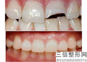 牙齿正畸手术怎么做(牙齿正畸手术怎么做的)