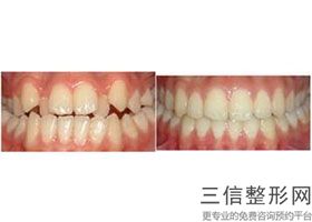 牙齿做过根管后做牙套到哪个科(牙齿做过根管后做牙套到哪个科室)