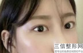 眼睛开眼角手术多少钱一次(眼睛开眼角手术多少钱一次啊)