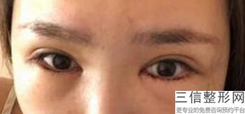 医院埋线双眼皮多少钱()