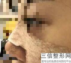 在韩国隆鼻多少钱(女孩割双眼皮较好年龄)