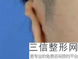 招风耳怎么矫正多少钱(招风耳矫正多少钱双侧)