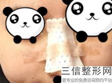 郑州欣美妡整形医院玻尿酸打鼻子价格()