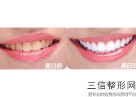 治蛀牙牙周炎多少钱(治蛀牙牙周炎多少钱一次)