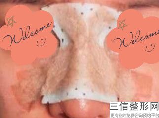 很便宜的隆鼻(很便宜的隆鼻方式)