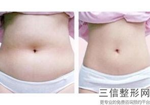 做大腿抽脂有什么危害嘛(做大腿抽脂有什么危害嘛女性)
