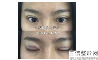 做个埋线的双眼皮大概需要多少钱(正规医院割双眼皮大概多少钱)