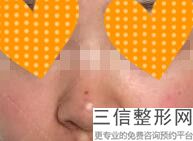 做假体隆鼻效果好吗多少钱(做假体隆鼻效果好吗多少钱一次)