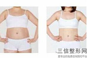2023常州水动力吸脂瘦腰腹医疗整形医院榜单前十位都是热门医美！江苏常州美莱整形美容医院均有上榜！