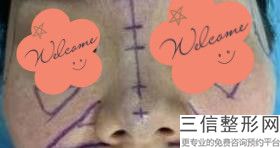 2023贵阳激光隆鼻排名榜10强整形医院权威综合！贵州贵阳丽都医疗美容医院这些实力医院供你选择
