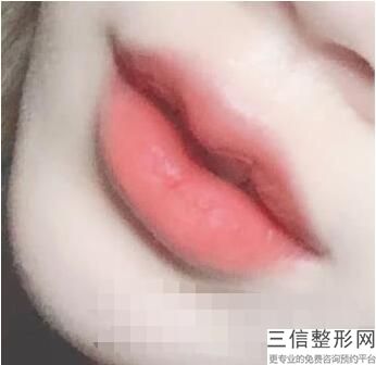 2023昆明嘟嘟唇整形整形医院前10位名单发布！昆明悦玲珑医疗美容诊所前三强口碑绝绝子