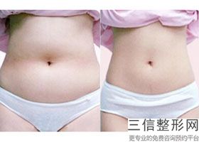 2023昆明溶脂针注射手臂排名榜前10位美容医院哪家技术牛？昆明圣雅医疗美容诊所口碑实力硬核在线