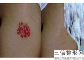 2023南京疤痕磨皮手术医院排行top10强哪家做得好？南京医科大学第二附属医院整形美容中心这些正规医院推荐给你