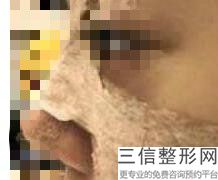 2023上海自体软骨注射隆鼻排名前十强美容医院精品机构整理！上海维瑟芝私密中心推荐指数五颗星