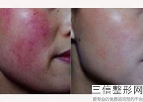 2023苏州皮肤祛痘坑整形美容医院名单揭晓！苏州科技城医院实力不可小觑