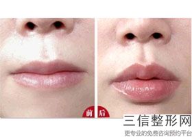 2023无锡玻尿酸丰嘟嘟唇大型美容医院口碑排行榜已整理好！无锡宜兴华美医疗美容门诊部实力口碑