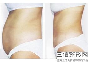 2023武汉光纤溶脂瘦大腿医疗整形医院在榜清单前十位已上新！武汉珍妮医疗美容门诊部都有实力傍身！