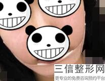2023郑州去除鼻唇沟整形医院排行前10位每日汇总!郑州蕴美医疗美容医院老牌医美口碑出众