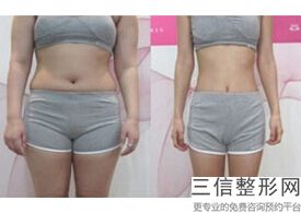 2023郑州深蓝小腿吸脂前十的整形医院超全盘点!郑州圣蓝医疗美容医院上榜理由重点介绍