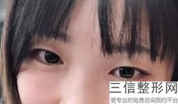 2023重庆硅胶假体隆眉弓医院前10口碑排行值得一览！重庆三峡中心医院百安分院烧伤整形美容外科这些不容错过的医院榜单