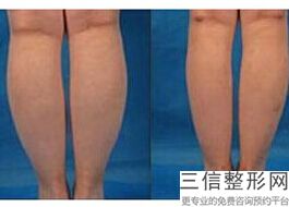 成都大小腿吸脂医疗美容医院效果好的有哪几个(成都大小腿吸脂医疗整形医院口碑榜前10强)