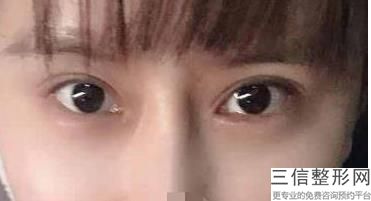 哈尔滨活细胞填充眼部整形医院值得去的有哪些家(哈尔滨活细胞填充眼部口碑TOP10强医疗整形医院)