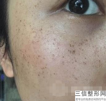 河南皮秒激光祛雀斑谁家医院更专业(河南皮秒激光祛雀斑医疗整形医院排行榜10强)