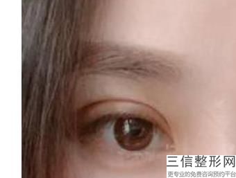 济南美雕去眼睛细纹整形美容医院哪些是正规的(济南美雕去眼睛细纹排行榜前10名整形医院)