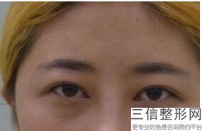 洛阳手术改善眼角皱纹哪里的整形医院好(洛阳手术改善眼角皱纹整形美容医院前10位口碑排行)