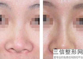 南京自体肋骨隆鼻反馈好的整形医院是哪个(南京自体肋骨隆鼻整形美容医院排名榜前10强)