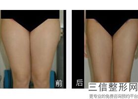 南宁小腿抽脂医院都有哪些口碑反馈好的(南宁小腿抽脂前10名医疗美容医院)