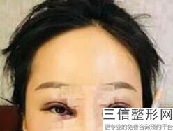 沈阳眼纹注射填充医院比较有名气的有哪些家(沈阳眼纹注射填充权威医院排名前10位)