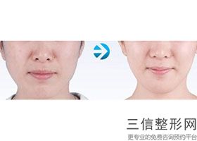 石家庄玻尿酸注射唇纹整形美容医院比较权威的有哪几家(石家庄玻尿酸注射唇纹正规医院排行榜前10名)