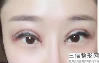 天津水光针去眼底纹医院哪个性价比高(天津水光针去眼底纹排名前十位医疗整形医院)