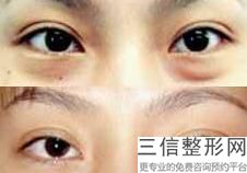武汉上眼睑去脂手术医院哪些是正规的(武汉上眼睑去脂手术正规医疗整形医院排行榜10强)