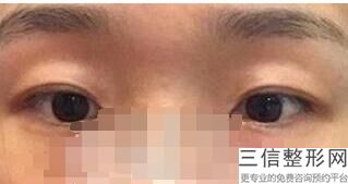 重庆干细胞填充眼睛细纹整形美容医院口碑好的有哪些家(重庆干细胞填充眼睛细纹评分前10位整形医院)